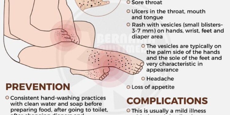13 cases of foot-hand-mouth disease detected in Kashmir so far: Director Health